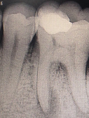 Radiografia antes do tratamento de canal