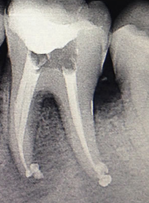 Radiografia depois do tratamento de canal